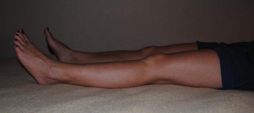 Ćwiczenia po leczeniu zapalenia przyczepu więzadła rzepki – poziom II