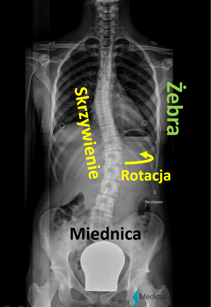 Skolioza &ndash; nie tylko skrzywienie, ale i rotacja kręgosłupa